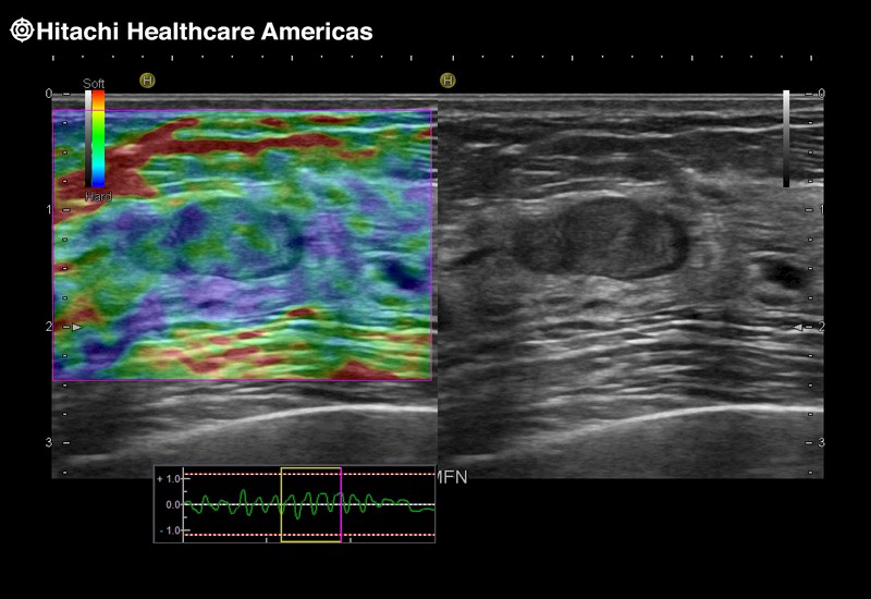 Breast Solid Lesion Elastography