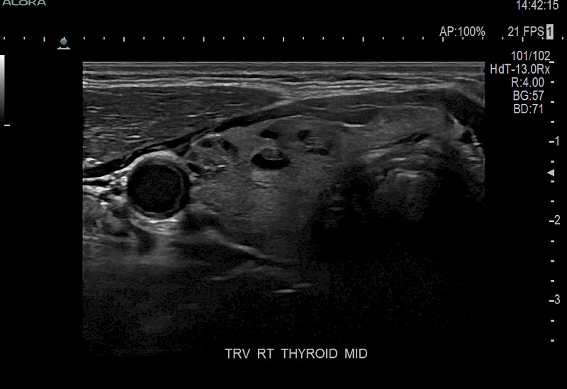 Thyroid Lesions 9