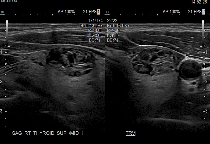 Thyroid Lesions Dual 9