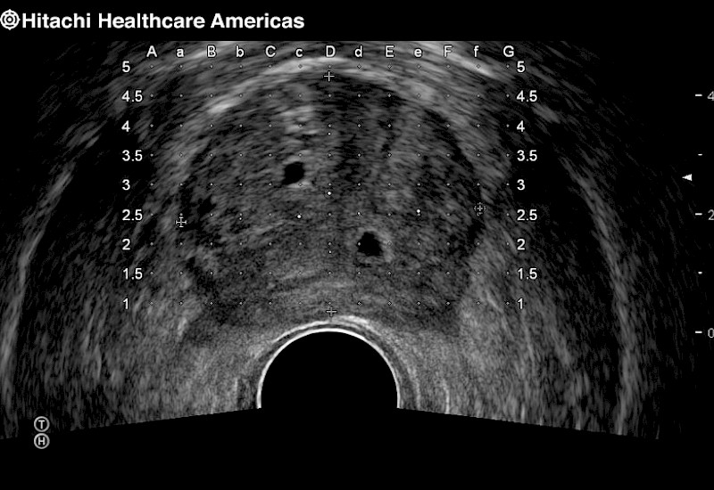 Prostate Cysts