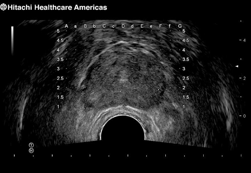 Prostate Grid