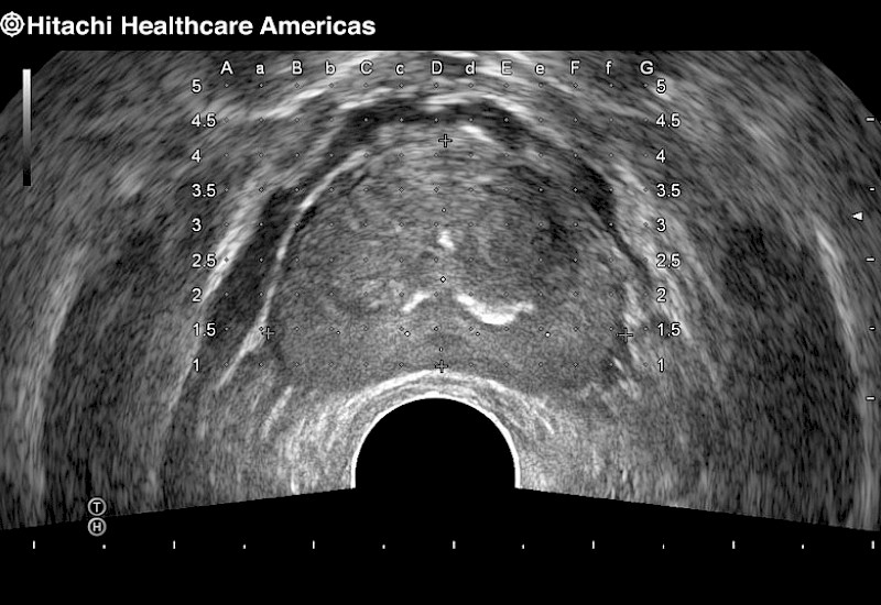 Prostate Grid