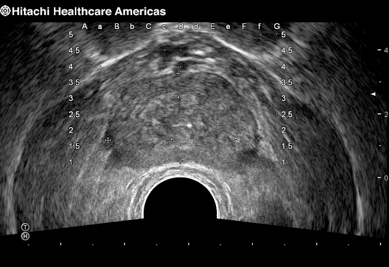 Prostate Grid