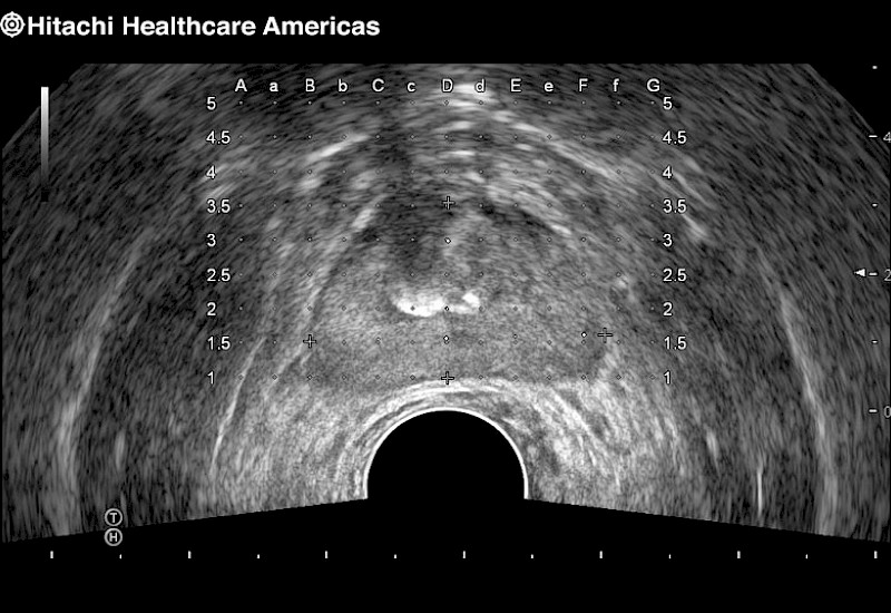 Prostate Grid Calcification