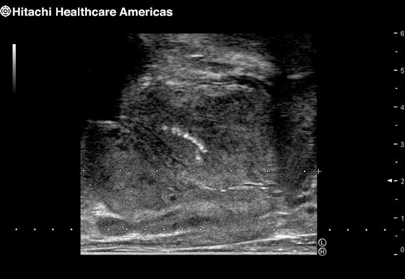 Prostate Calcification