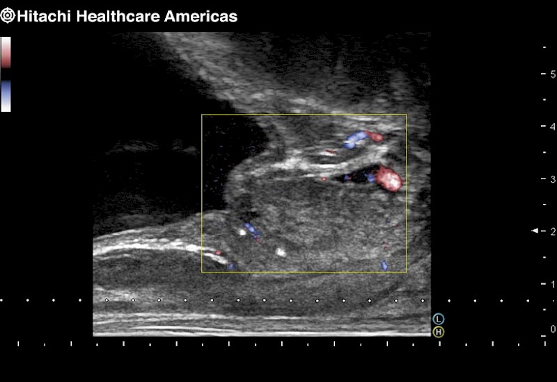 Prostate with Color Doppler