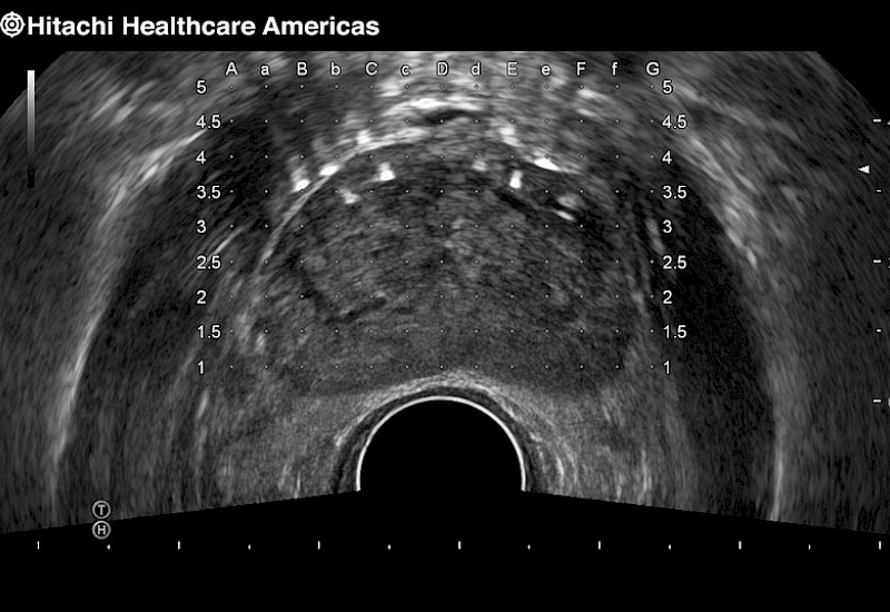 Prostate Brachy with Seeds