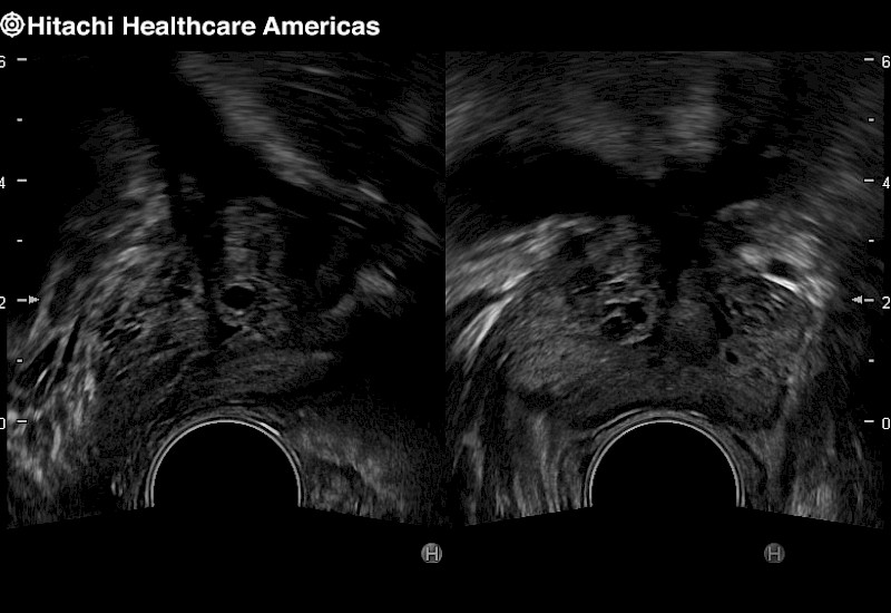 Prostate Dual Screen