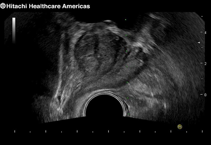 Urology Prostate Biopsy