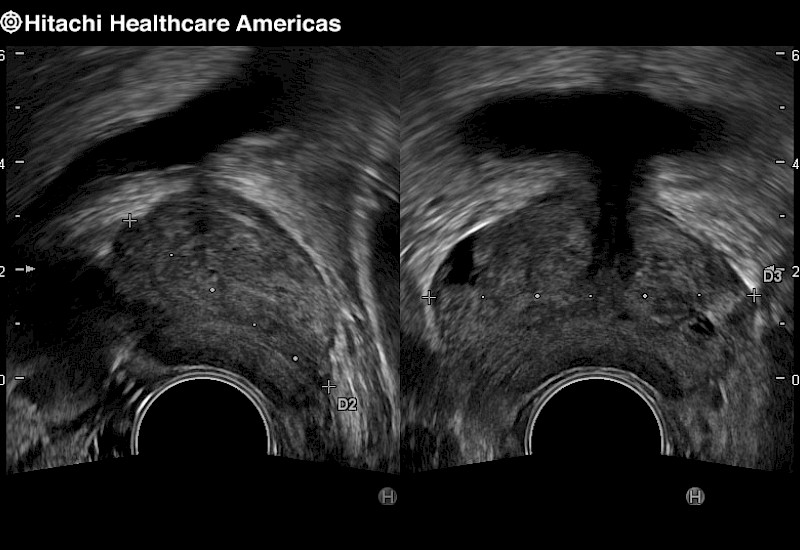 Prostate Dual Screen